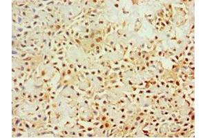 Immunohistochemistry of paraffin-embedded human breast cancer using ABIN7161640 at dilution of 1:100 (KLRC1 Antikörper  (AA 114-233))