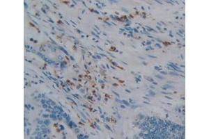 IHC-P analysis of Human Rectum Cancer Tissue, with DAB staining. (PTPRQ Antikörper  (AA 36-294))