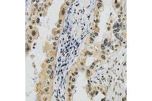 Immunohistochemical analysis of SUPT16H staining in human lung cancer formalin fixed paraffin embedded tissue section.