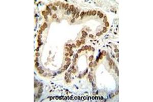 BTG2 Antibody (N-term) immunohistochemistry analysis in formalin fixed and paraffin embedded human prostate carcinoma followed by peroxidase conjugation of the secondary antibody and DAB staining.