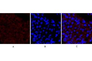 Immunofluorescence analysis of human liver cancer tissue. (PTGS2 Antikörper  (AA 530-610))