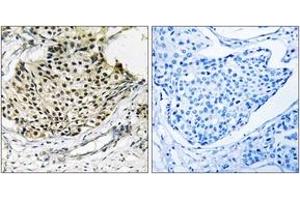 Immunohistochemistry analysis of paraffin-embedded human breast carcinoma, using IKK-gamma (Phospho-Ser31) Antibody. (IKBKG Antikörper  (pSer31))