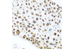 Immunohistochemistry of paraffin-embedded human lung cancer using METTL3 antibody. (METTL3 Antikörper  (AA 1-156))