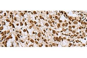 Immunohistochemistry of paraffin-embedded Human esophagus cancer tissue using MYEF2 Polyclonal Antibody at dilution of 1:70(x200) (MYEF2 Antikörper)