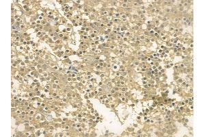 ABIN6262802 and ABIN6273129 at 1/100 staining human pituitary adenoma by IHC-P. (KIF12 Antikörper  (N-Term))