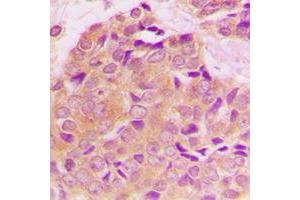 Immunohistochemical analysis of 14-3-3 zeta (pS58) staining in human breast cancer formalin fixed paraffin embedded tissue section. (14-3-3 zeta Antikörper  (pSer58))