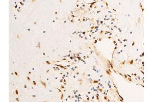 ABIN6267303 at 1/100 staining human glioma tissue sections by IHC-P. (C-JUN Antikörper  (pSer63))