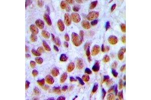 Immunohistochemical analysis of RUNX1 staining in human breast cancer formalin fixed paraffin embedded tissue section. (RUNX1 Antikörper)