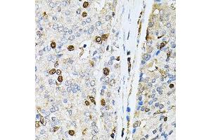 Immunohistochemistry of paraffin-embedded human prostate cancer using PNKP antibody. (PNKP Antikörper  (AA 60-320))