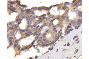 IHC analysis of DLST using anti-DLST antibody (ABIN7599412). (DLST Antikörper  (AA 1-453))