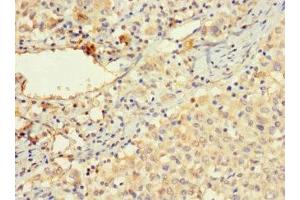 Immunohistochemistry of paraffin-embedded human lung cancer using ABIN7175557 at dilution of 1:100