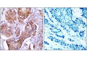 Immunohistochemistry analysis of paraffin-embedded human breast carcinoma, using Estrogen Receptor-alpha (Phospho-Ser106) Antibody. (Estrogen Receptor alpha Antikörper  (pSer106))