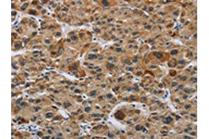 The image on the left is immunohistochemistry of paraffin-embedded Human liver cancer tissue using ABIN7191086(IL31 Antibody) at dilution 1/20, on the right is treated with synthetic peptide. (IL-31 Antikörper)