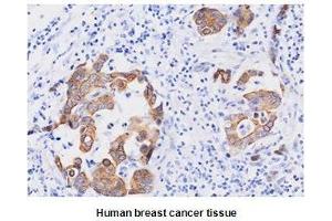 Paraffin embedded sections of human breast canitrocelluloseer tissue were initrocelluloseubated with anti-human FADD (1:50) for 2 hours at room temperature. (FADD Antikörper  (AA 1-208))