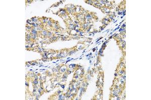Immunohistochemistry of paraffin-embedded human gastric cancer using EPB41 antibody (ABIN1872554) at dilution of 1:100 (40x lens). (EPB41 Antikörper)