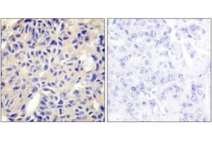 Immunohistochemistry analysis of paraffin-embedded human breast carcinoma tissue, using Collagen V alpha2 Antibody.