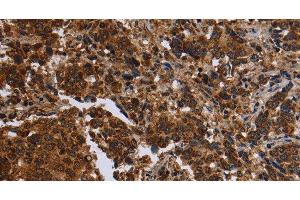 Immunohistochemistry of paraffin-embedded Human liver cancer tissue using FMN2 Polyclonal Antibody at dilution 1:30 (Formin 2 Antikörper)
