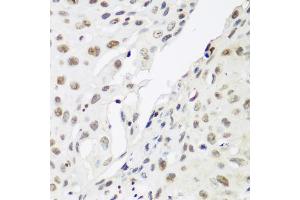 Immunohistochemistry of paraffin-embedded human lung cancer using CBX3 antibody. (CBX3 Antikörper)