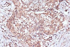 Immunohistochemistry of paraffin-embedded human esophageal cancer using B Rabbit mAb (ABIN7265849) at dilution of 1:100 (40x lens). (BAG2 Antikörper)