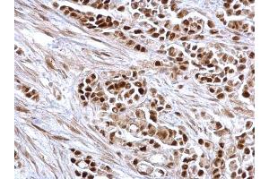 IHC-P Image Rb antibody detects Rb protein at nucleus on human colon carcinoma by immunohistochemical analysis. (Retinoblastoma 1 Antikörper  (C-Term))