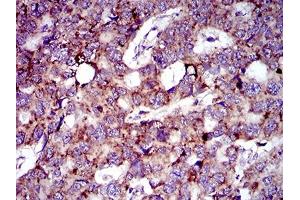 Immunohistochemical analysis of paraffin-embedded esophageal cancer tissues using MRPL42 mouse mAb with DAB staining. (MRPL42 Antikörper  (AA 10-142))