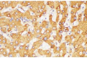 Immunohistochemistry of paraffin-embedded Human liver using FGB Polycloanl Antibody at dilution of 1:200 (Fibrinogen beta Chain Antikörper)