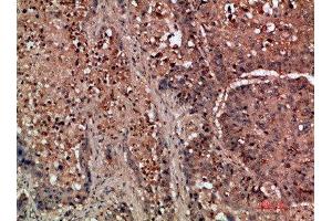 Immunohistochemical analysis of paraffin-embedded human-lung-cancer, antibody was diluted at 1:200 (DDR2 Antikörper  (AA 31-80))