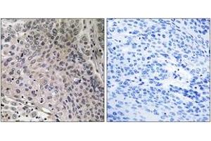 Immunohistochemistry analysis of paraffin-embedded human breast carcinoma tissue, using TEBP (Ab-113) Antibody. (NKX2-1 Antikörper  (AA 79-128))