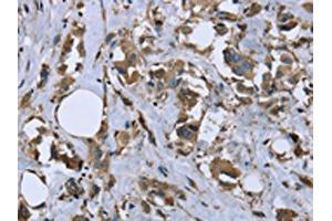 The image on the left is immunohistochemistry of paraffin-embedded Human breast cancer tissue using ABIN7130317(MYL12B Antibody) at dilution 1/20, on the right is treated with fusion protein. (MYL12B Antikörper)