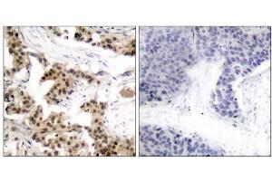 Immunohistochemical analysis of paraffin-embedded human breast carcinoma tissue using NF-κB p105/p50 (phospho-Ser893) antibody (E011018). (NFKB1 Antikörper  (pSer893))
