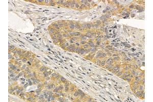 EPHB4 Mouse Monoclonal Antibody at 1/100 staining human lung cancer and adjacent non-tumor tissue by IHC-P.