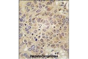 Forlin-fixed and paraffin-embedded hun hepatocarcino tissue reacted with RS antibody (C-term) (ABIN392313 and ABIN2841964) , which was peroxidase-conjugated to the secondary antibody, followed by DAB staining. (Mars (MARS) (AA 872-899), (C-Term) Antikörper)