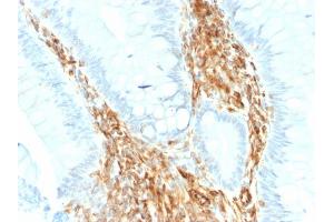 Formalin-fixed, paraffin-embedded human Colon Carcinoma stained with Vimentin Rabbit Recombinant Monoclonal Antibody (VIM/1937R). (Rekombinanter Vimentin Antikörper)