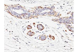 Formalin-fixed, paraffin-embedded human Breast Carcinoma stained with SM-MHC Mouse Monoclonal Antibody (MYH11/923). (MYH11 Antikörper)