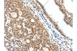 The image on the left is immunohistochemistry of paraffin-embedded Human thyroid cancer tissue using ABIN7192279(SCN2A Antibody) at dilution 1/25, on the right is treated with synthetic peptide. (SCN2A Antikörper)