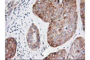 Immunohistochemical staining of paraffin-embedded Adenocarcinoma of Human breast tissue using anti-LCMT1 mouse monoclonal antibody. (LCMT1 Antikörper)