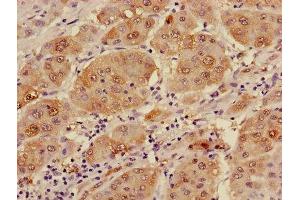 Immunohistochemistry of paraffin-embedded human liver cancer using ABIN7143645 at dilution of 1:100 (ADH1B Antikörper  (AA 2-375))