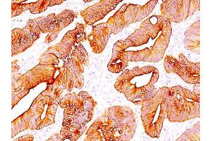Formalin-fixed, paraffin-embedded human Colon Carcinoma stained with Multi Cytokeratin Mouse Monoclonal Antibody (C11). (KRT4, KRT5, KRT6, KRT8, KRT10, KRT13, KRT18 Antikörper)