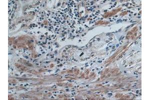 IHC-P analysis of Human Stomach Cancer Tissue, with DAB staining. (IDE Antikörper  (AA 753-973))