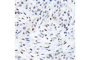 Immunohistochemistry of paraffin-embedded human esophageal cancer using TFE3 Rabbit mAb (ABIN1683323, ABIN3015205, ABIN3015206 and ABIN7101320) at dilution of 1:100 (40x lens). (TFE3 Antikörper)
