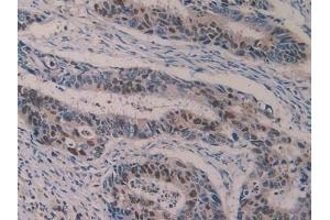 Detection of 5-LO in Human Colorectal cancer Tissue using Polyclonal Antibody to 5-Lipoxygenase (5-LO)