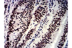 Immunohistochemical analysis of paraffin-embedded rectum cancer tissues using NAGR1 mouse mAb with DAB staining. (HNRNPM Antikörper  (AA 17-161))