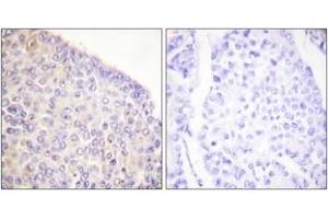 Immunohistochemistry analysis of paraffin-embedded human breast carcinoma, using SYK (Phospho-Tyr525) Antibody. (SYK Antikörper  (pTyr525))