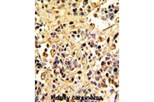 Formalin-fixed and paraffin-embedded human kidney carcinoma with Neprilysin Antibody (C-term), which was peroxidase-conjugated to the secondary antibody, followed by DAB staining. (MME Antikörper  (C-Term))