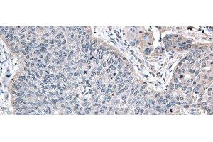 Immunohistochemistry of paraffin-embedded Human lung cancer tissue using ZFAND5 Polyclonal Antibody at dilution of 1:35(x200) (ZFAND5 Antikörper)