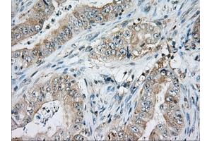Immunohistochemical staining of paraffin-embedded Adenocarcinoma of Human ovary tissue using anti-CD5 mouse monoclonal antibody. (CD5 Antikörper)