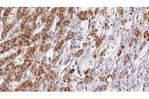 ABIN6278126 at 1/100 staining Human liver cancer tissue by IHC-P. (SEMA4D/CD100 Antikörper  (C-Term))