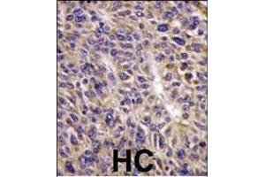 Formalin-fixed and paraffin-embedded human hepatocarcinoma reacted with UBE2L6 Antibody (N-term) (ABIN1882146 and ABIN2839155) , which was peroxidase-conjugated to the secondary antibody, followed by DAB staining. (UBE2L6 Antikörper  (N-Term))