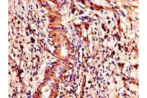 Immunohistochemistry of paraffin-embedded human gastric cancer using ABIN7148300 at dilution of 1:100 (COMMD1 Antikörper  (AA 2-190))
