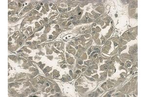 ABIN6256977 and ABIN6275032 at 1/100 staining human renal cell carcinoma by IHC-P.
